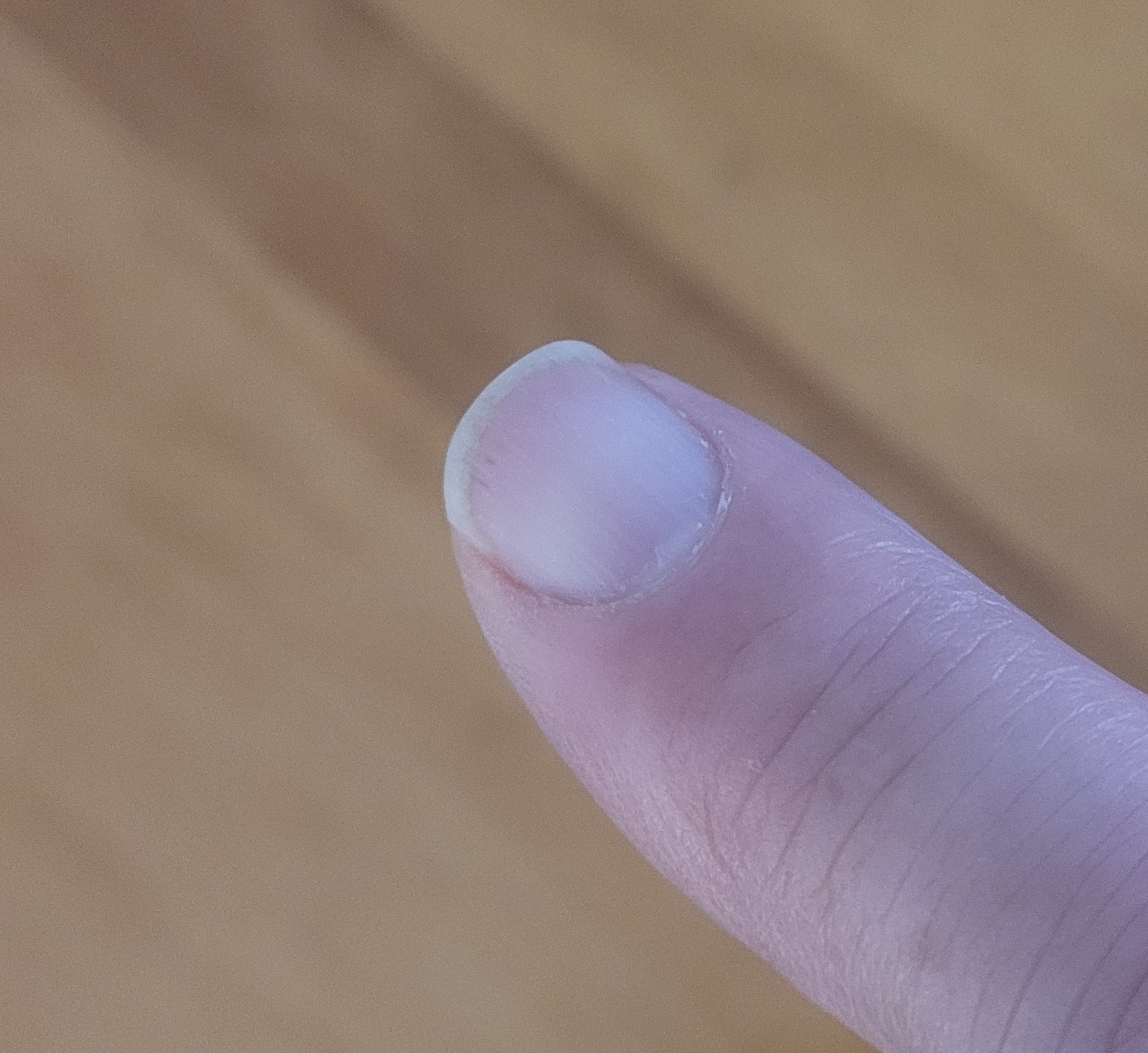 אצבע ציפורן כתר קצרה